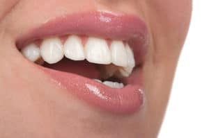 veneers in Albuquerque NM | Dr. Steven Holbrook