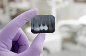 Debunking 3 Myths Surrounding Dental X-Rays | Steven E. Holbrook, DMD | Albuquerque, NM