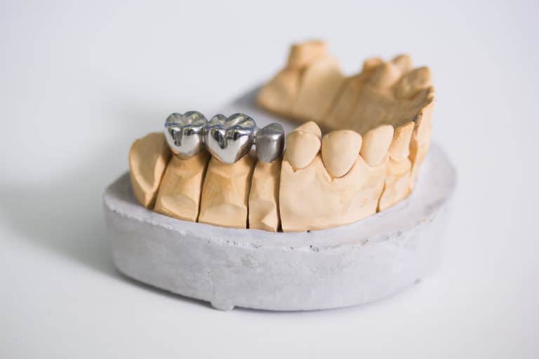 Broken Dental Bridge? How to Fix It Steven E. Holbrook, DMD