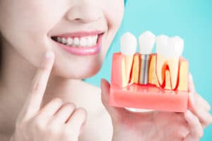 Dental Implant Treatment Albuquerque NM