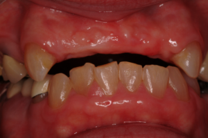 Before Dental bridges by Dr. Steven E. Holbrook
