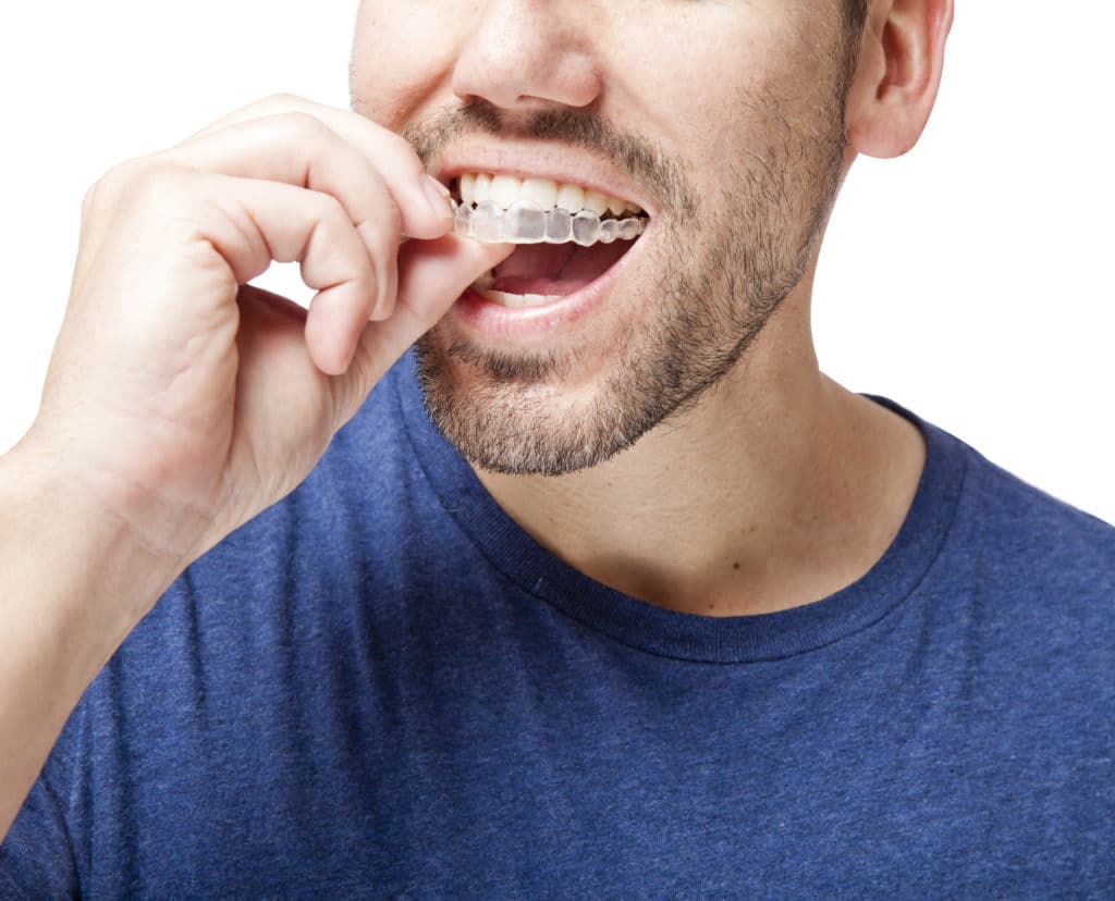 A stock photo of a man trying on Invisalign