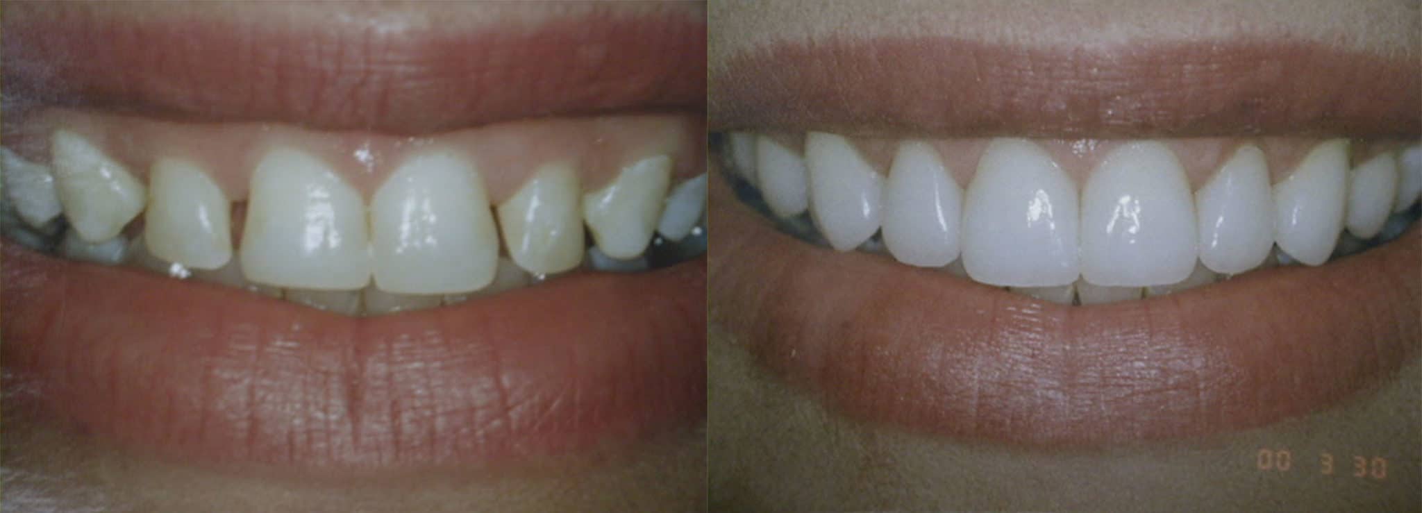 Before & After Of Porcelain Veneers Albuquerque, NM