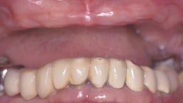 before and after dental implants Albuquerque, NM