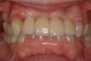before and after dental implants Albuquerque, NM
