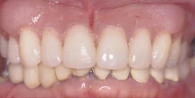DentalImplantAfter
