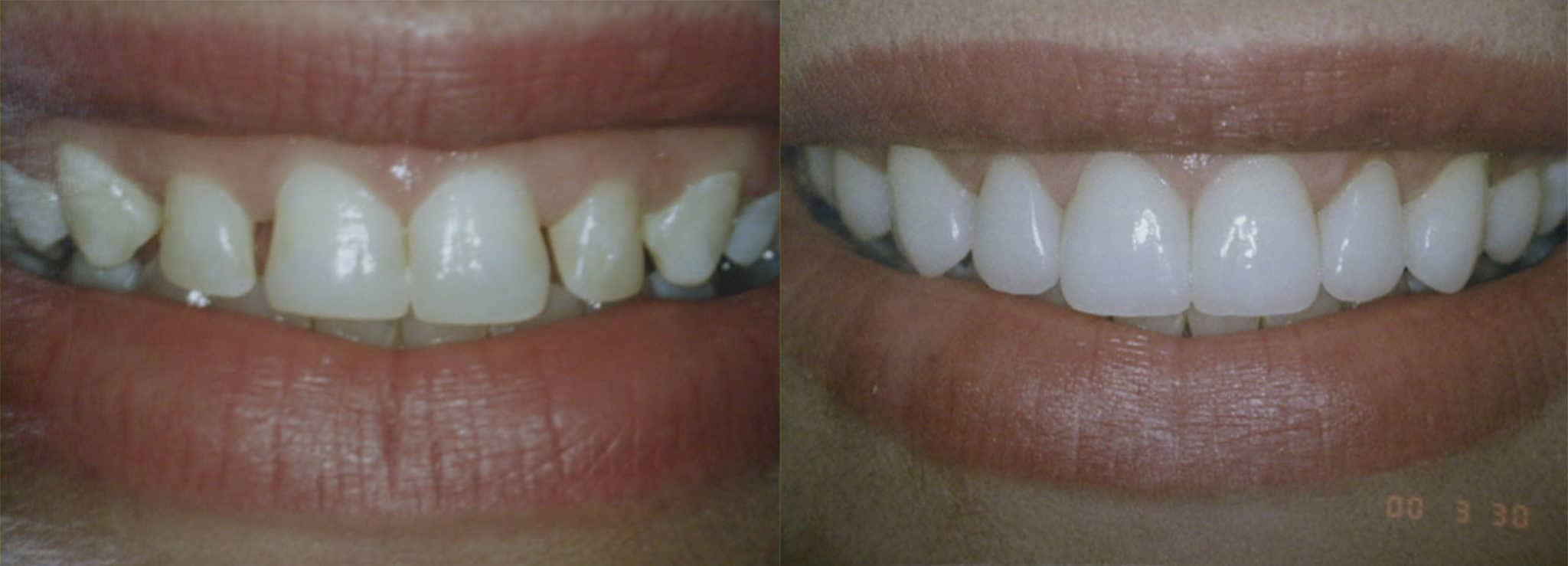 Porcelain Veneers in albuquerque, nm dr. steven holbrook