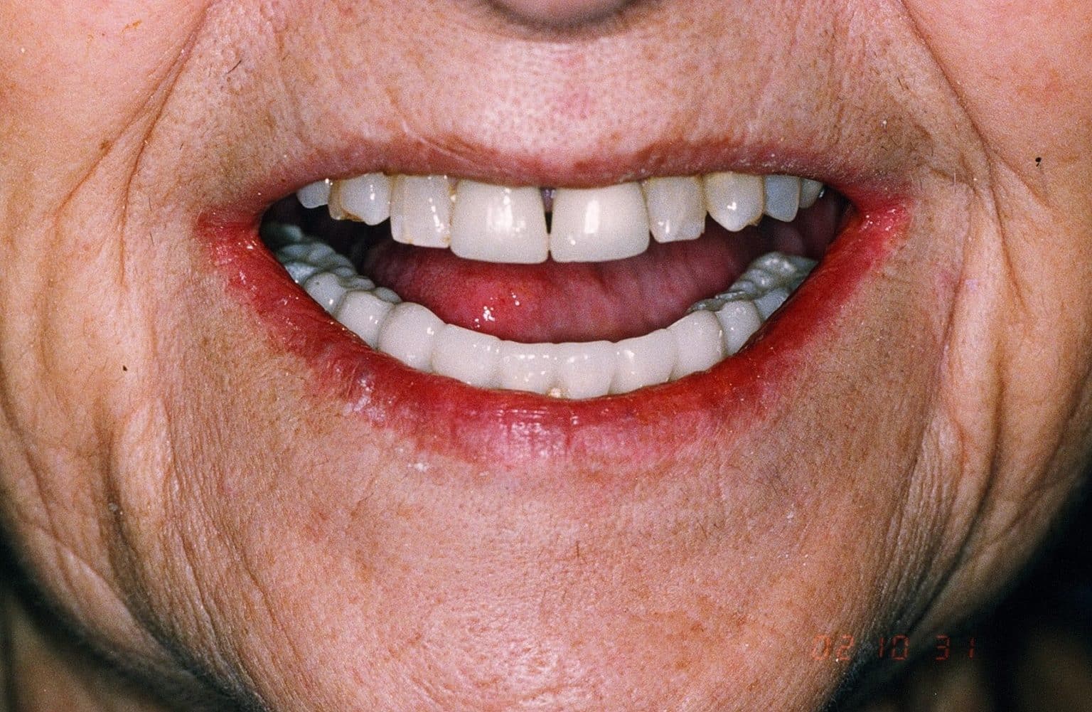 Porcelain Dental Crowns in Albuquerque, NM Dr. Steven Holbrook