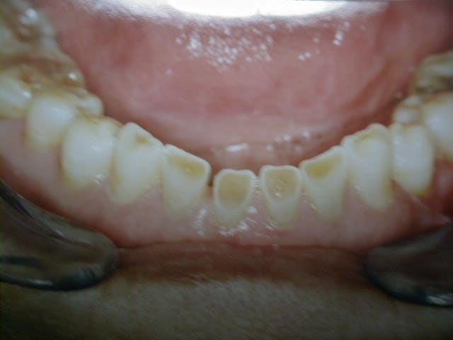 porcelain crowns 3 berore 1