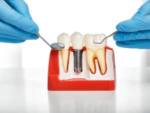 Dental,Prosthetics,Concept.,Showing,The,Installation,Of,A,Dental,Implant
