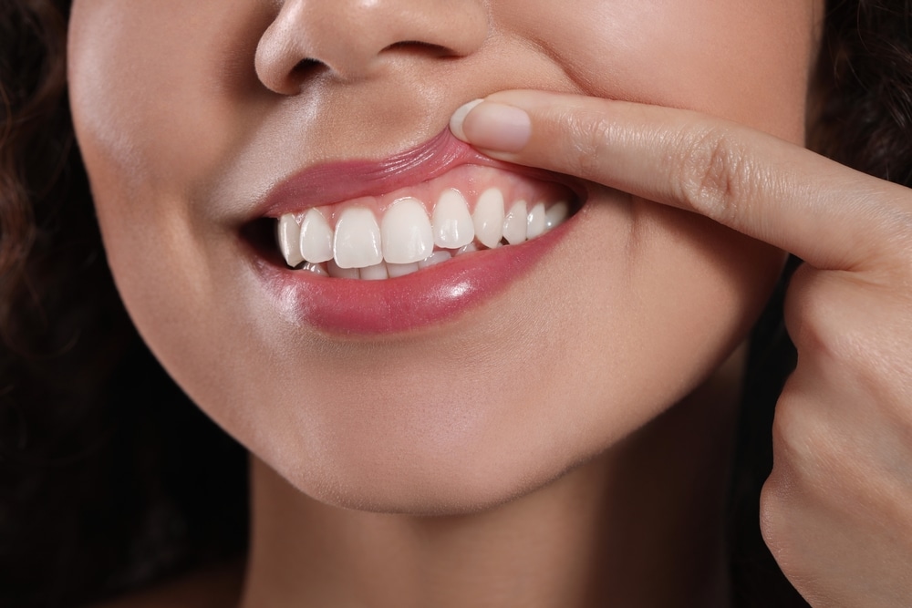 Woman lifts her lips to show her healthy gums after overcoming gingivitis.