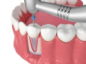 Digital image depiction of a root canal procedure saving an unhealthy tooth.