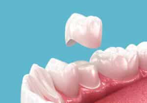 Dental crown fits over the top of a natural tooth to create a seamless smile